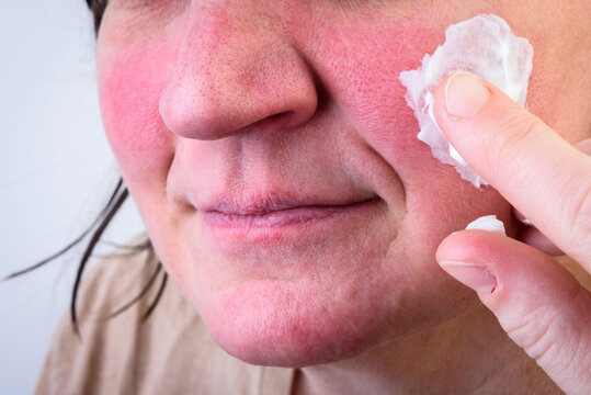 Redness of the woman's face after frost and strong wind on a gray background.