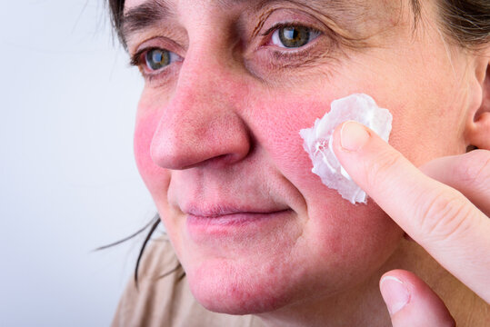 Redness of the woman's face after frost and strong wind on a gray background.