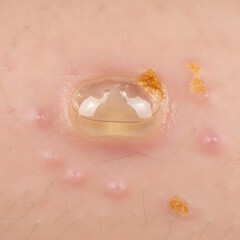Fototapeta premium Close-up of a large, fluid-filled bulla on human skin, a characteristic sign of bullous impetigo