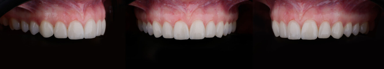 Female upper jaw after dental prosthetic correction with six ultra thin ceramic veneers. © gorynvd