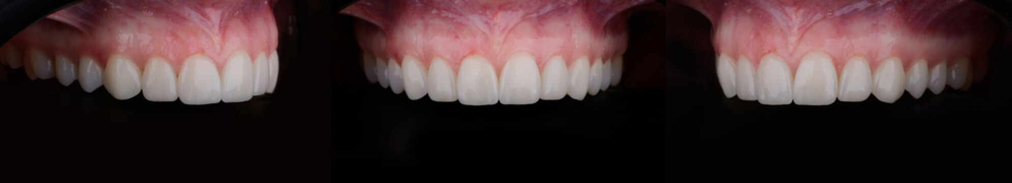 Female upper jaw after dental prosthetic correction with six ultra thin ceramic veneers.