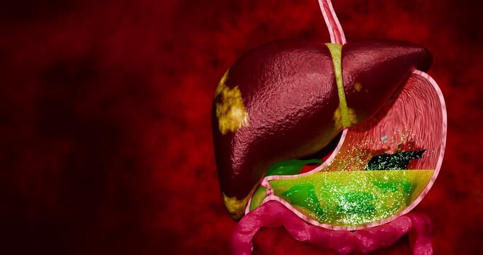 Liver Disease Concept Linking Fatty Liver and Cancer with Fast Food Diet Sleep Deprivation and Sedentary Lifestyle in Medical Anatomy 3D Rendering
