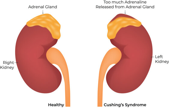 Cushing's Syndrome Adrenaline Overproduction in Adrenal Glands