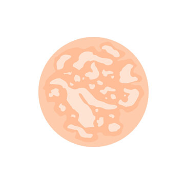 Fungal Tinea versicolor vector illustration 