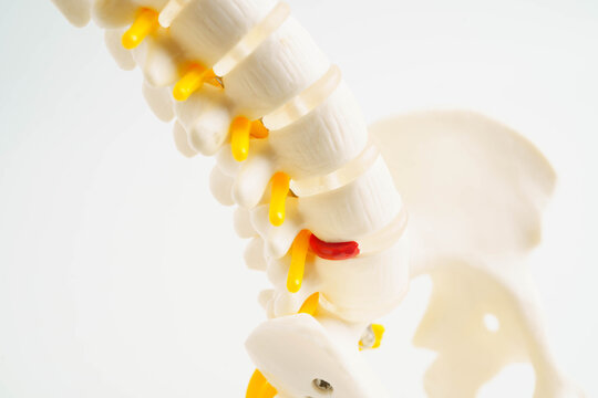 Spinal nerve and bone, Lumbar spine displaced herniated disc fragment, Model for treatment medical in the orthopedic department.