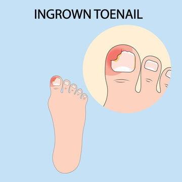 Vector illustration of ingrown toenail showing redness, swelling, pain, and infection, with related conditions such as paronychia, nail fungus, and toe inflammation.