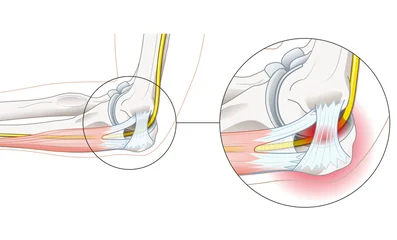 Cubital tunnel syndrome with compressed ulnar nerve medical illustration © Axel Kock