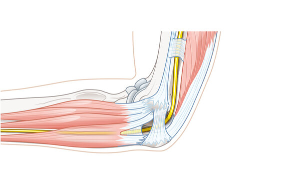 Cubital tunnel syndrome anatomy showing ulnar nerve entrapment structures