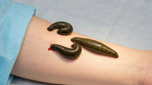 Medical leeches placed on human arm during treatment session  