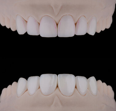 Dental ceramic veneers made of e.max for fixation to the frontal teeth. Before and after staining