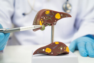 Cirrhosis, Liver cancer, fatty liver, Asian doctor with liver human model.