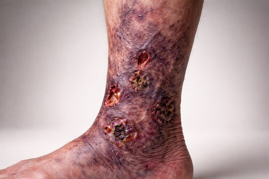 Leg ulcer infected wound varicose vein vascular disease diabetic foot skin infection chronic ulcer medical condition human leg closeup medical concept leg ulcer infected wound varicose vein