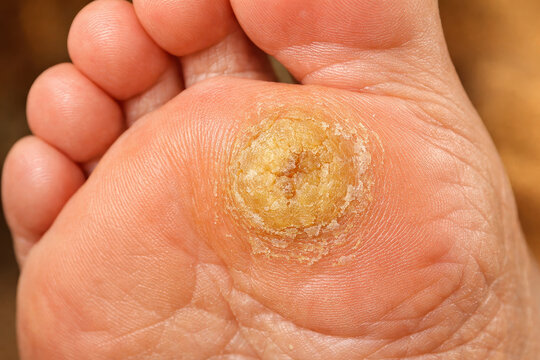 Plantars wart foot skin disease health care concept with focus on hard callus texture showing blood supply and sugar risk factor for diabetic patient needing glucose and insulin control