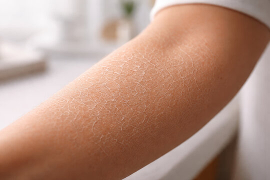 Dry skin dehydrated skin forearm closeup human arm flaky skin skin texture skin care dermatology health rough skin cracked skin skin surface epidermis sensitive skin irritation skin condition