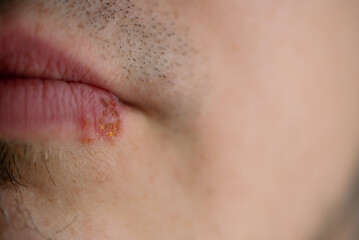 Fototapeta premium Person's lip clearly showing the painful blister and crusted lesion caused by herpes simplex virus (hsv-1), indicating a common viral infection requiring medical attention