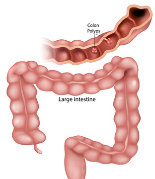 Medical illustration of large intestine anatomy showing colon polyps on inner intestinal wall. Educational digestive system diagram. Gastroenterology and colorectal disease