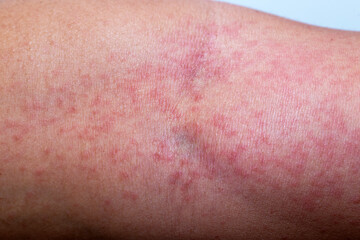 Fototapeta premium Close-up photo of a man’s arm with red itchy skin rash and inflammation caused by insect bite or chemical contact, showing allergic dermatitis, irritation, and skin reaction on human body.