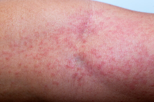 Close-up photo of a man&rsquo;s arm with red itchy skin rash and inflammation caused by insect bite or chemical contact, showing allergic dermatitis, irritation, and skin reaction on human body.