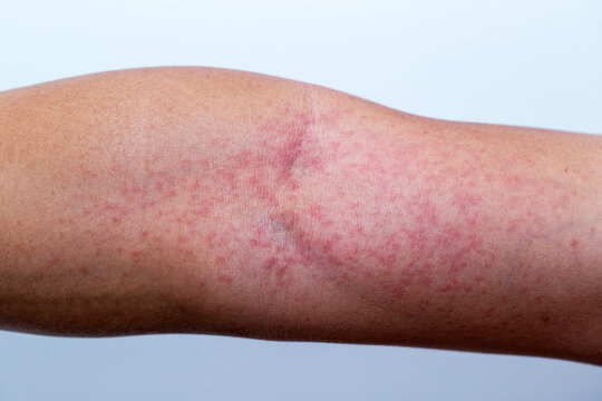 Close-up photo of a man&rsquo;s arm with red itchy skin rash and inflammation caused by insect bite or chemical contact, showing allergic dermatitis, irritation, and skin reaction on human body.