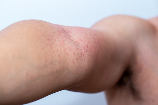 Close-up photo of a man&rsquo;s arm with red itchy skin rash and inflammation caused by insect bite or chemical contact, showing allergic dermatitis, irritation, and skin reaction on human body.