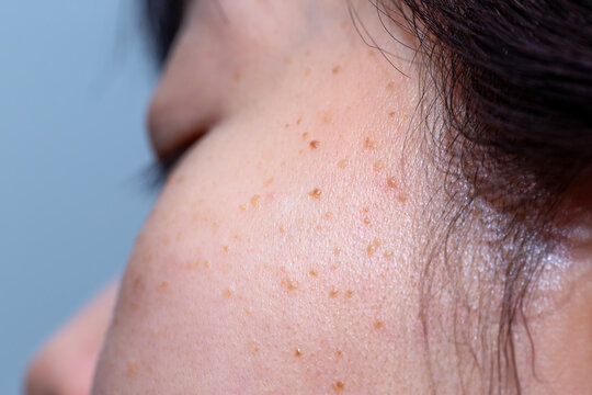 Close-up in seborrheic keratosis, pore, acne and wrinkles in face woman uneven skin. Facial care skin problems for beauty and cosmetic background concept.	