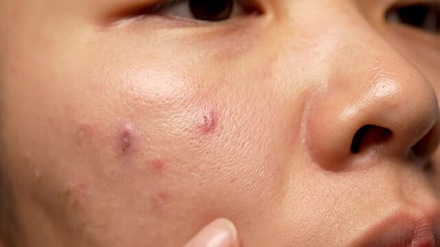 Close-up of human face with skin imperfections, highlighting blemishes and texture