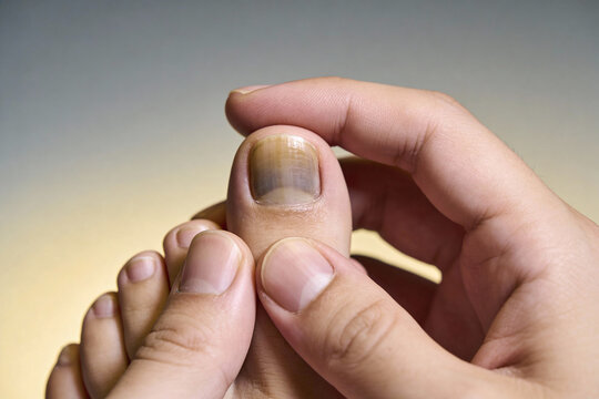 Close-up of a person holding a big toe with a dark bruised toenail. Concept for foot injury, nail damage, health problem, and medical examination of toes in natural light.