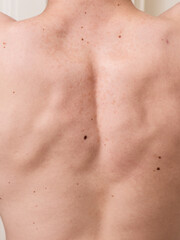 Human upper back skin with natural moles and freckles.