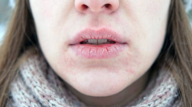 Close-up of cracked lips and dry skin in winter air