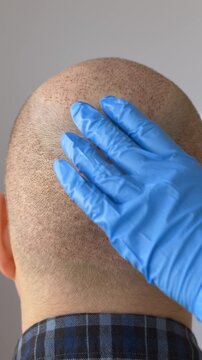 Assessment After Scalp Grafting Procedure, Doctor Reviews Scalp Status With Crusts And Grafts Present, Examination Of Scalp Condition After Grafting Procedure Including Crusts And Healing Progress