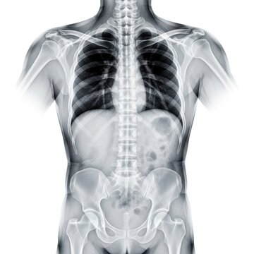 Detailed human torso X-ray showing spine, ribs, lungs, and pelvis. Medical radiography image for healthcare, diagnostics, anatomy education, and medical technology concepts