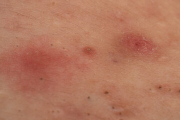 Fototapeta premium Close up acne skin texture with pimple and pore detail. Pimple in close up shows acne with whitehead comedone and sebum. Acne close up pimple for dermatology. Close up acne skin problem papules.