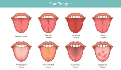 Illustration of tongue symptoms and health. medical illustration. © Bulgakova Kristina
