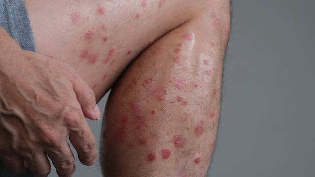 The early signs of redness on the skin that then dries and flare up to become Psoriasis Guttate on leg.