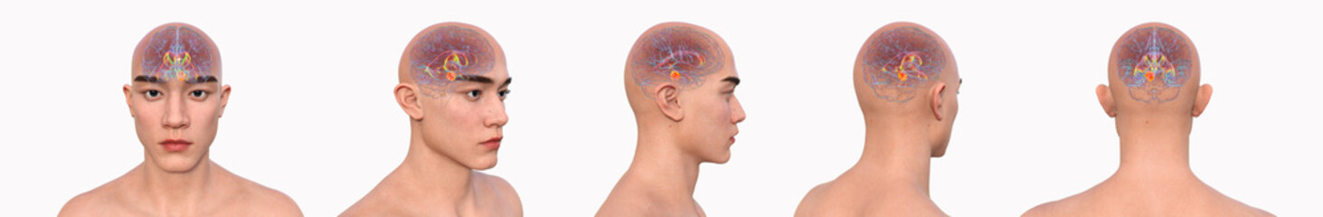 A brain tumor causing hydrocephalus, 3D illustration