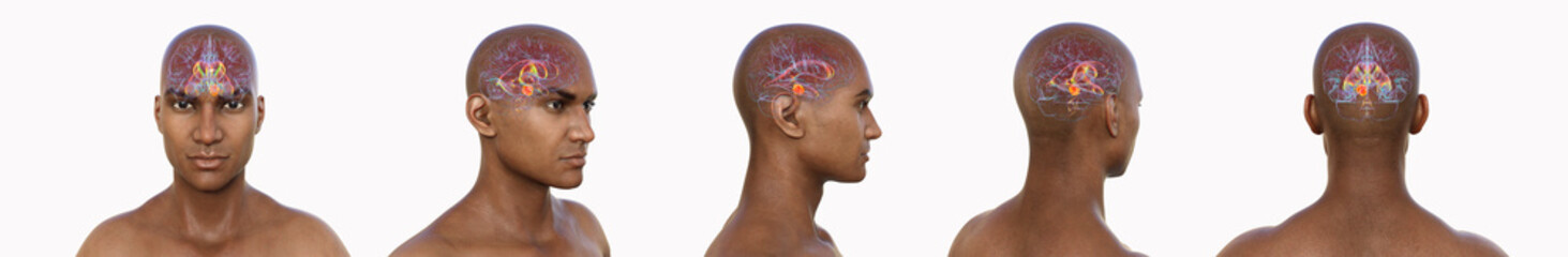 A brain tumor causing hydrocephalus, 3D illustration