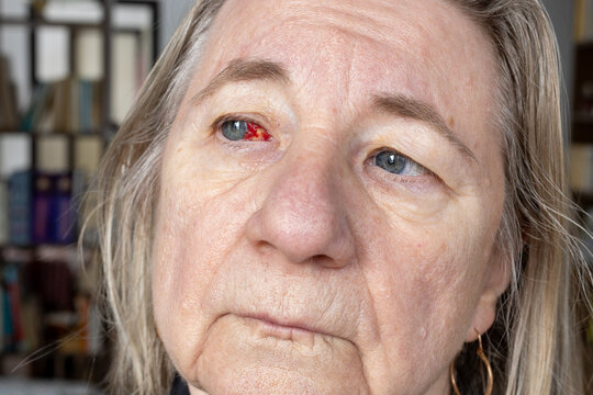 Senior woman portrait with subconjunctival hemorrhage
