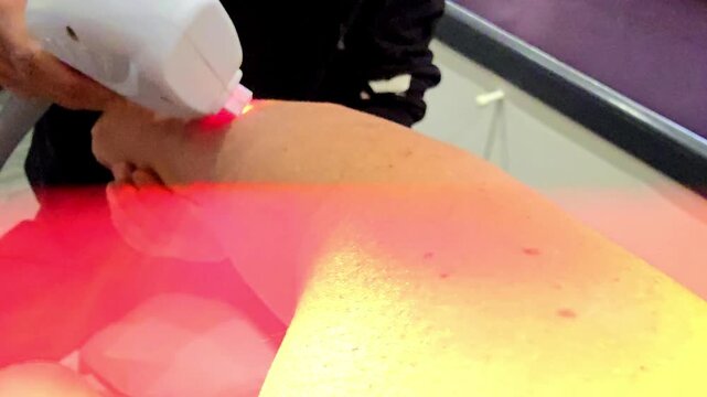 Performing a treatment with a device at a laser hair removal clinic