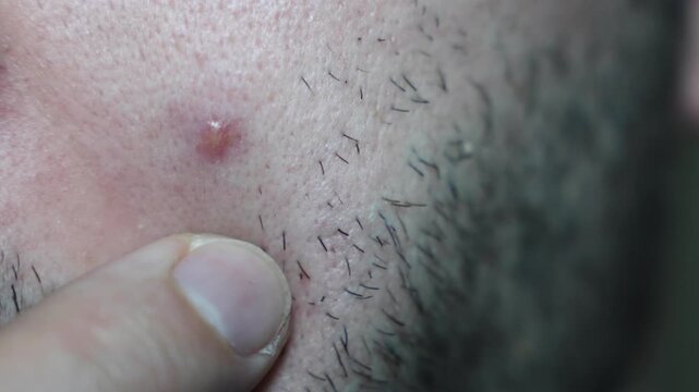 Macro close-up of a small acne blemish on male facial skin with short beard hair. Static camera captures detailed skin texture after squeezing, showing an imperfection in a calm indoor scene.