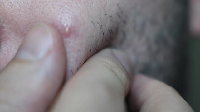 Macro close-up of fingers squeezing a small pimple on facial skin with short beard hair. Static camera focuses on skin texture and manual pressure during a personal skincare moment indoors.