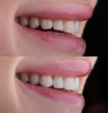 Female six frontal teeth makeover with ceramic ultra-thin aesthetic veneers. Before and after