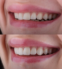Obraz premium Female six frontal teeth makeover with ceramic ultra-thin aesthetic veneers. Before and after