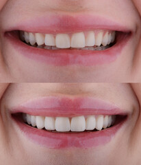 Obraz premium Female six frontal teeth makeover with ceramic ultra-thin aesthetic veneers. Before and after