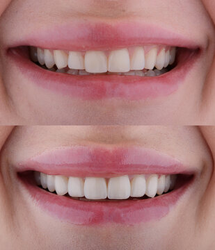 Female six frontal teeth makeover with ceramic ultra-thin aesthetic veneers. Before and after