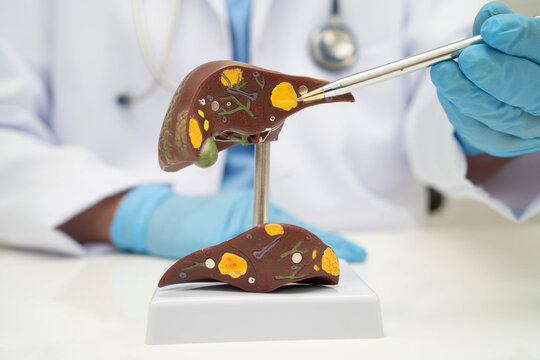 Cirrhosis, Liver cancer, fatty liver, Asian doctor with liver human anatomy model in World Hepatitis Day at hospital.