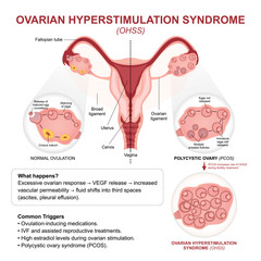 Ovarian Hyperstimulation Syndrome (OHSS) Flashcard