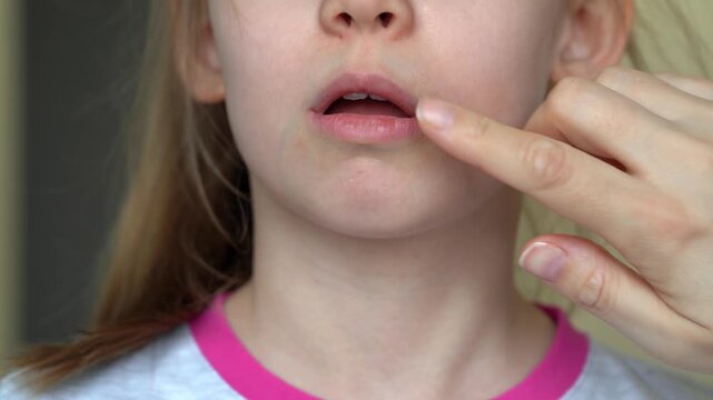 Mothers hand applies ointment to mouth of child with angular stomatitis. Girls face with perleche. Angulit. Disease illness. Medicine. Healthcare