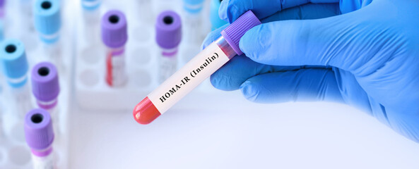 Fototapeta premium Doctor Holding HOMA IR Blood Test Tube in Modern Laboratory, Insulin Resistance Analysis, Diabetes Risk Assessment, Metabolic Health Diagnostics and Medical Research Concept