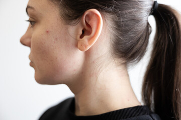 Side profile portrait of a young woman with acne on her face. Natural skin with pimples and imperfections. Dermatology, skincare issues, facial skin problems, beauty, health and real skin concept. © IVANNA