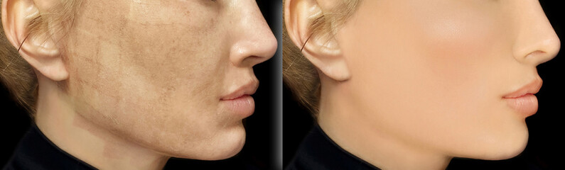 Obraz premium CO2 laser treatment ,Cosmetic Laser Dermatology 